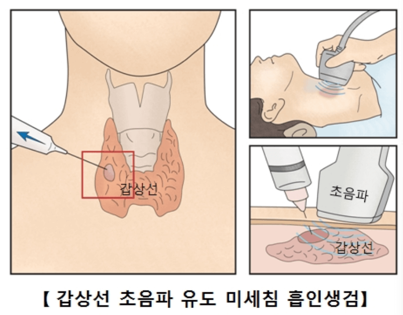 갑상선 암의 종류 및 증상