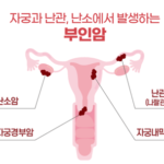 난소암의 원인 증상 치료방법 및 생존율