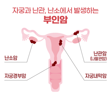 난소암의 원인 증상 치료방법 및 생존율