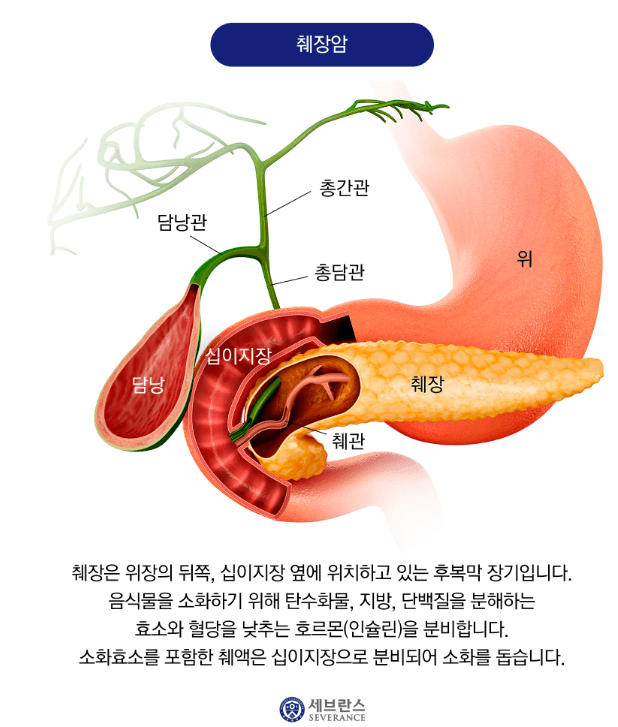 췌장암의 원인 증상 생활습관 예방방법