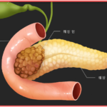 췌장암의 원인 증상 생활습관 예방방법