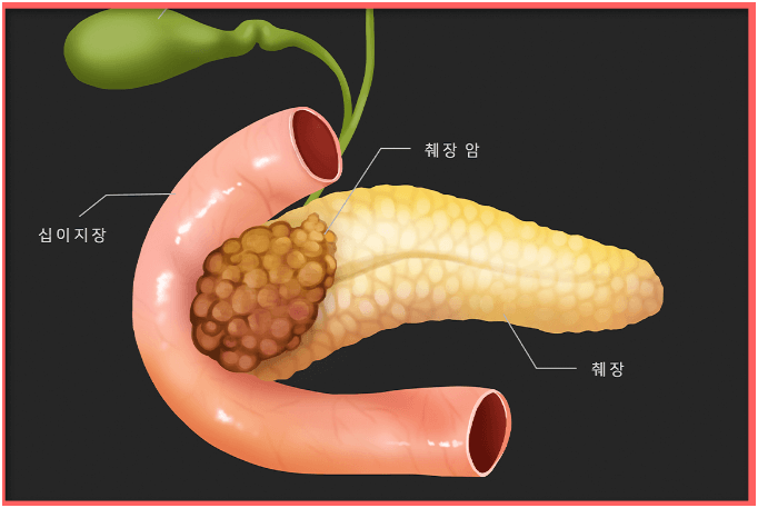 췌장암의 원인 증상 생활습관 예방방법